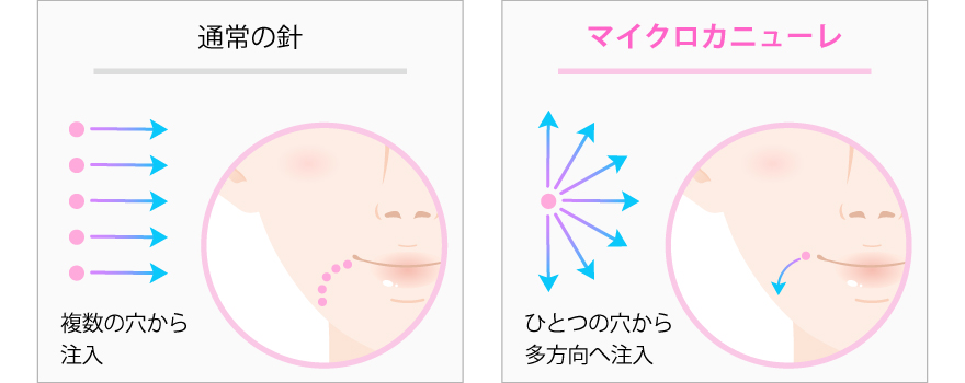 通常の針 複数の穴から注入、マイクロカニューレ ひとつの穴から多方向へ注入