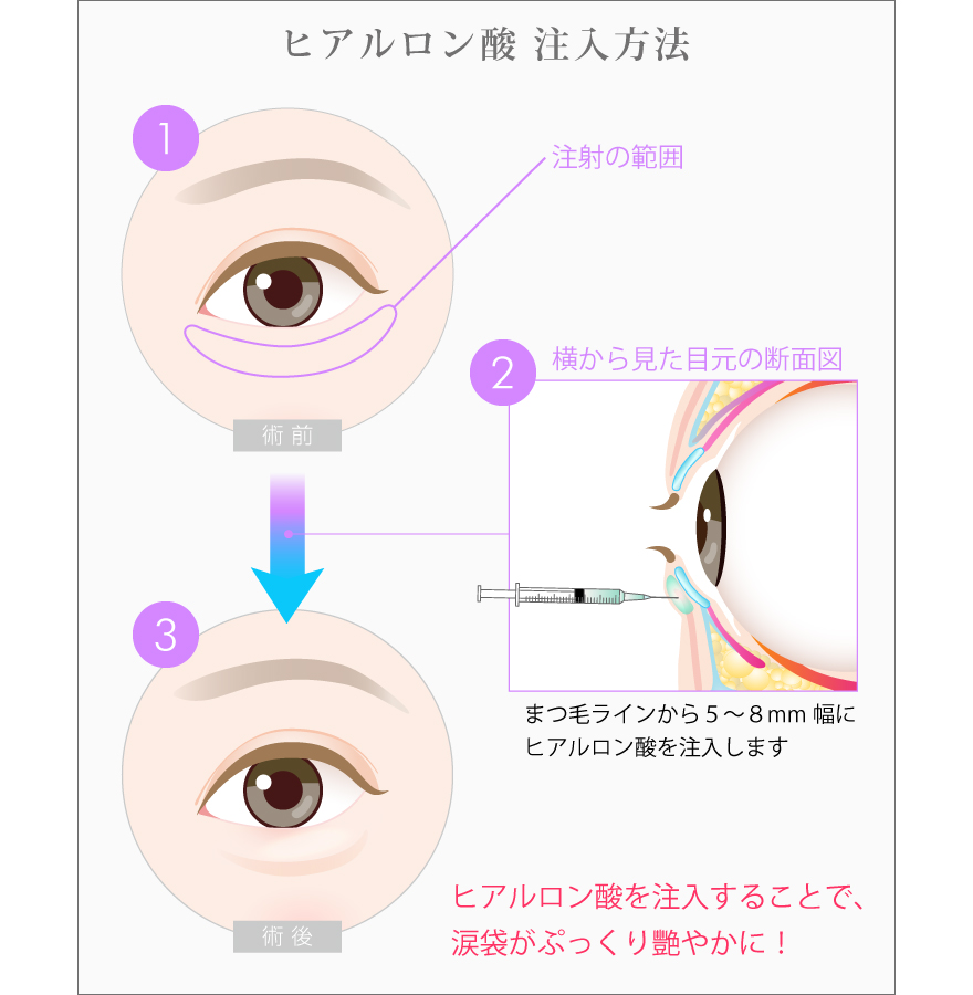 涙袋形成の術前・術後