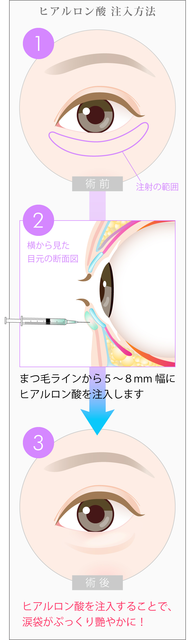 涙袋形成の術前・術後