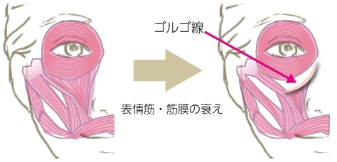 目の周囲の筋肉の下にできるゴルゴ線