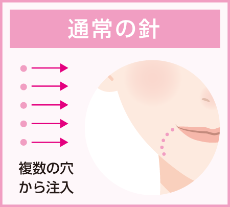 通常の針・複数の穴から注入