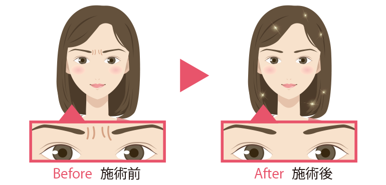 眉間のしわ整形