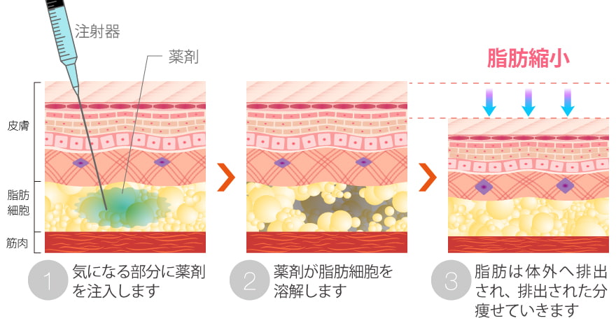 脂肪溶解注射で顔痩せが促される仕組み