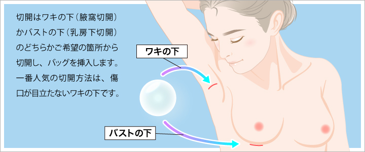 切開はワキの下やバストの下から行います