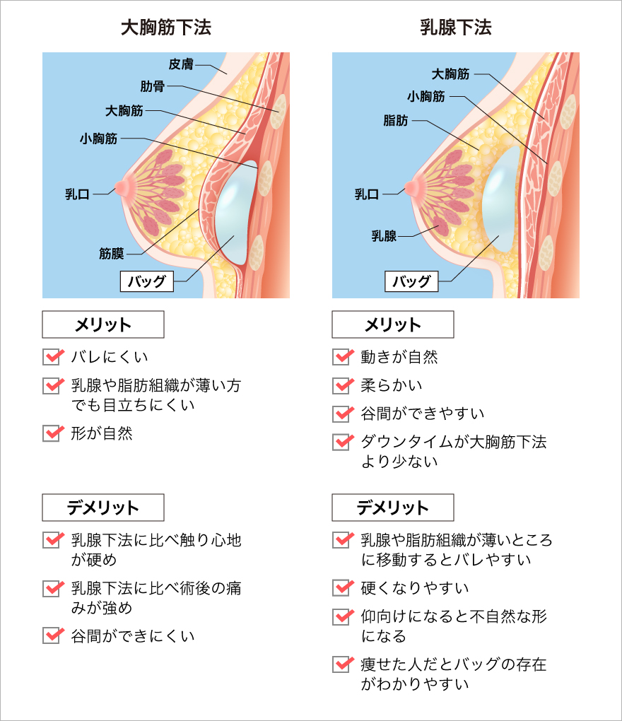 大胸筋下法と乳腺下法のメリット・デメリット