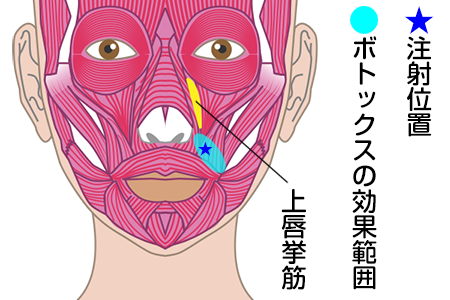 ガミースマイルボトックス注射