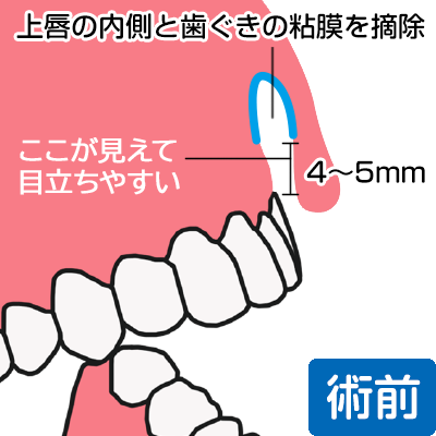 ガミースマイル整形手術「上唇の粘膜を切除」