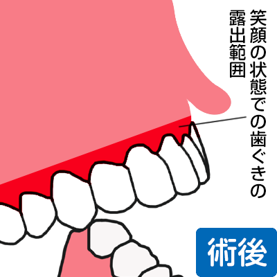 笑った状態でも歯茎が見える範囲が狭まった