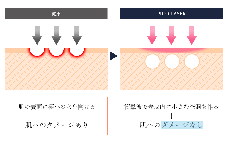 ピコフラクショナルは高密度のレーザーを照射・衝撃波によって表皮の内側に微小な空洞を作り、その刺激によってコラーゲン生成を促します。