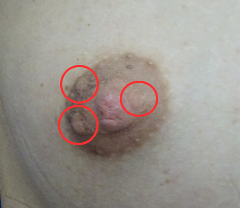 モントゴメリー腺（乳輪のぶつぶつ）の成功例の一部写真ビフォー01