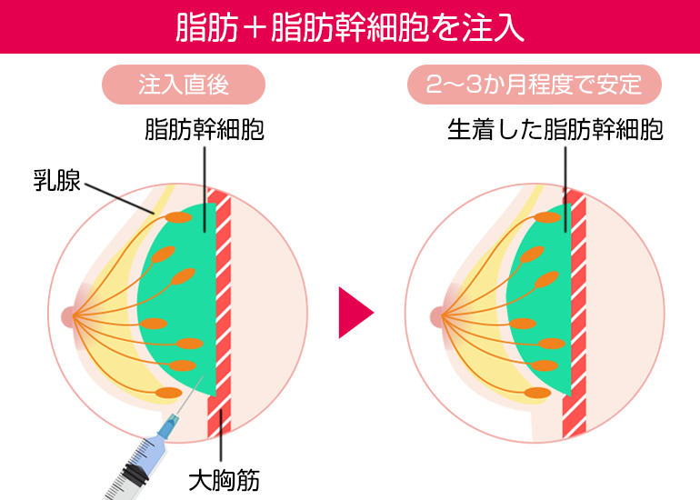 脂肪だけでなく濃縮された質のいい活性化した脂肪幹細胞も同時に注入することで、しこり・石灰化・壊死を防止し、脂肪定着率が上がります