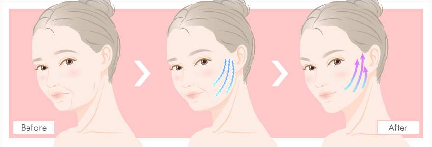 糸リフト（スレッドリフト）ってなに？