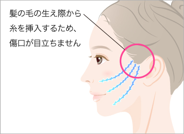 糸によるリフトアップ整形方法