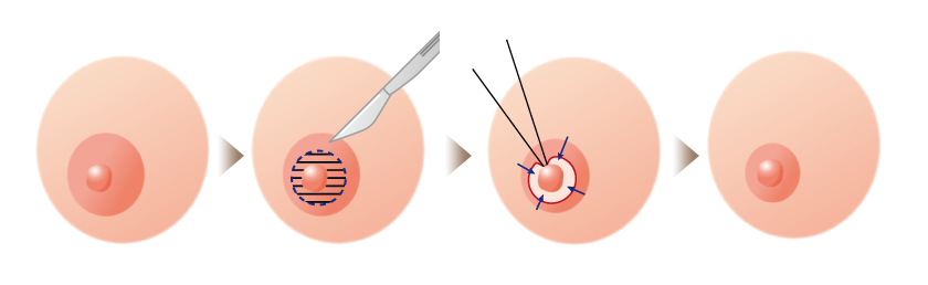 乳輪縮小術の手術方法1内側（乳頭周り）切除法