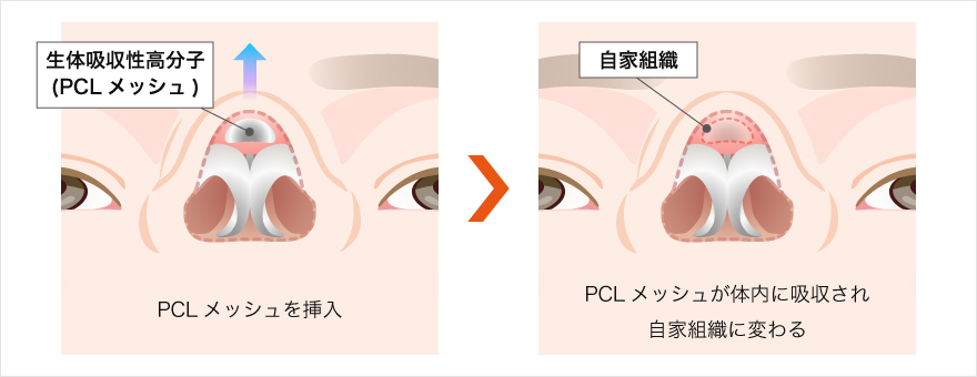 生体吸収性高分子（PCLメッシュ）が挿入後自家組織に変わる