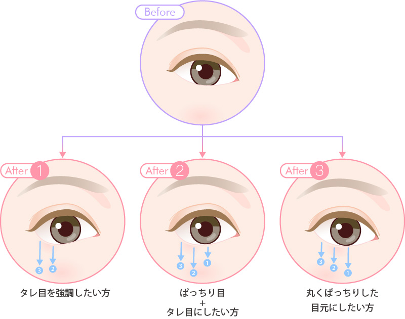 タレ目形成術3パターンの手術方法