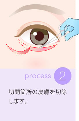 2：切開箇所の皮膚を切除します