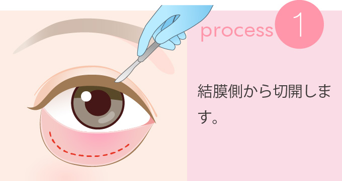 1：結膜側から切開します