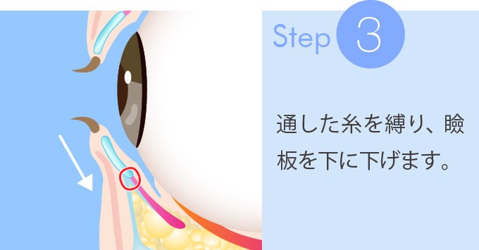 3：通した糸を縛り、瞼板を下に下げます