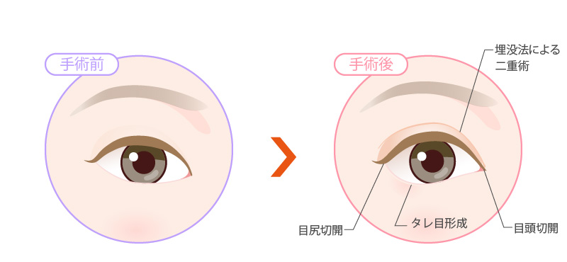タレ目形成と埋没法の二重と目尻切開と目頭切開