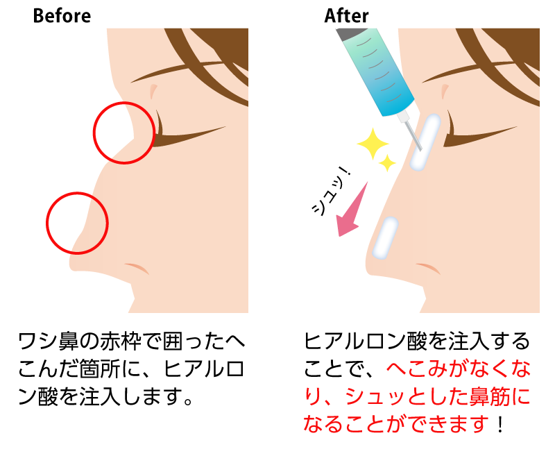 鷲鼻の凹んだ箇所にヒアルロン酸を注入することで、まるで整形したような綺麗な鼻筋になれます。