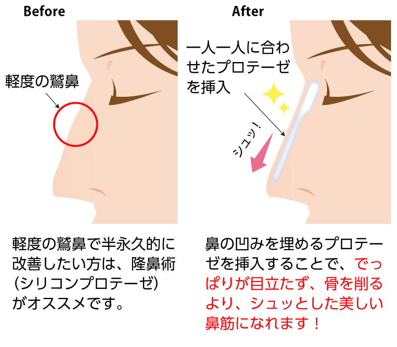 鼻にプロテーゼを挿入することで、でっぱりを目立たなくし、なおかつ一直線で綺麗な鼻筋を作ることができます。