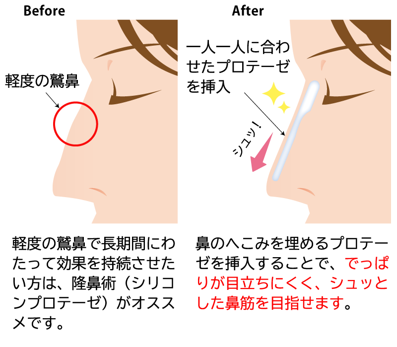 鼻にプロテーゼを挿入することで、でっぱりを目立たなくし、なおかつ一直線で綺麗な鼻筋を作ることができます。