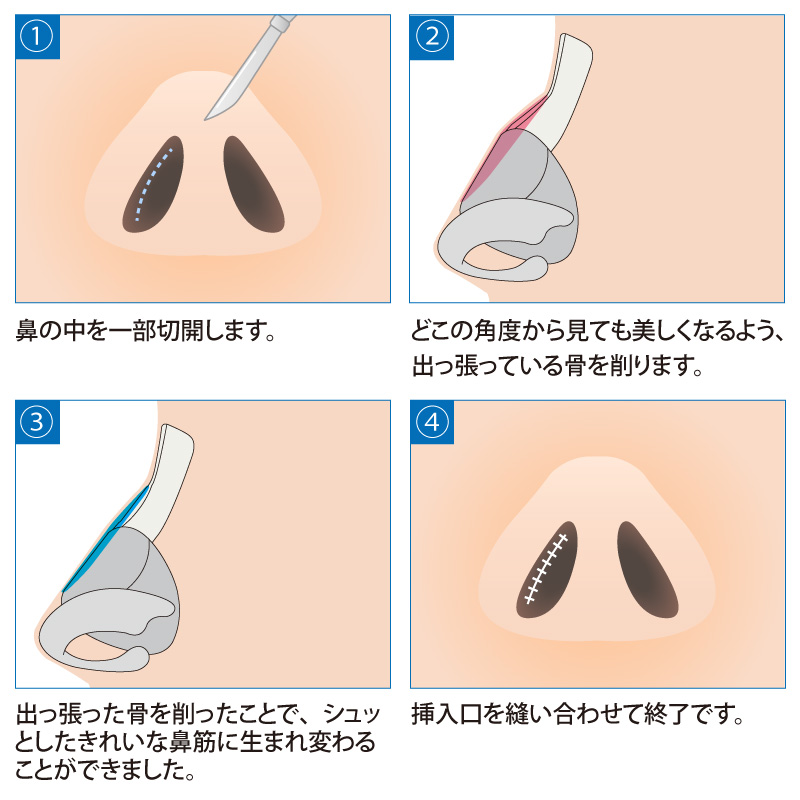 鷲鼻の手術方法です。鼻の中を切開しますので、傷跡は目立ちません。