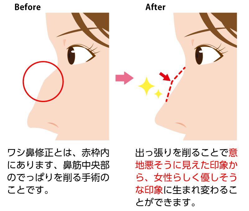 鷲鼻は鼻筋中央部の出っ張りを切除すれば、女性らしい印象の素敵な鼻になれます。