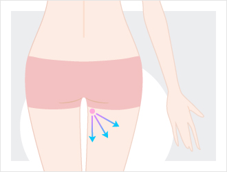 脂肪の採取部位