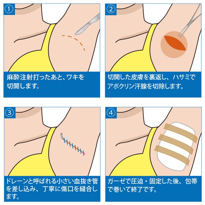 ワキガ手術の一つ、剪除法の手術方法