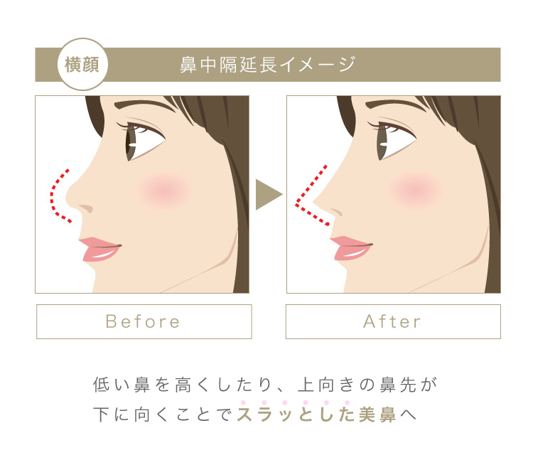 鼻中隔延長術の術前術後イメージ 横顔