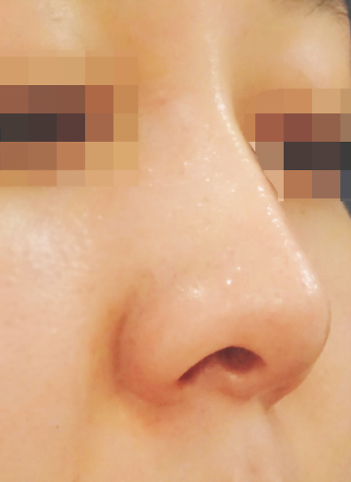 鼻中隔延長-症例写真-ビフォーアフター