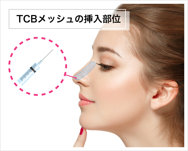 TCBメッシュ