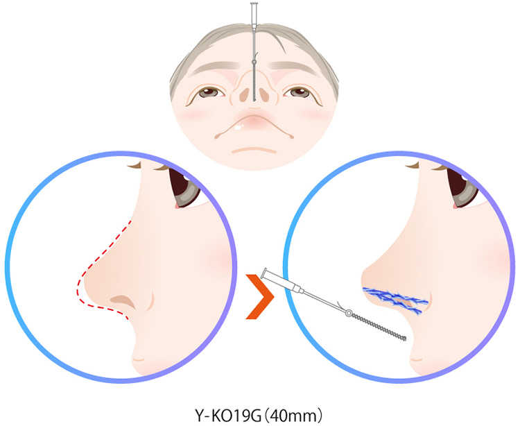 鼻中隔延長に適した n-COGのY-KO（ワイコ）は19G（40mm）