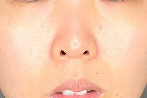 切らない鼻中隔延長-症例写真-ビフォーアフター