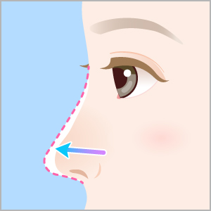 切らない鼻中隔延長