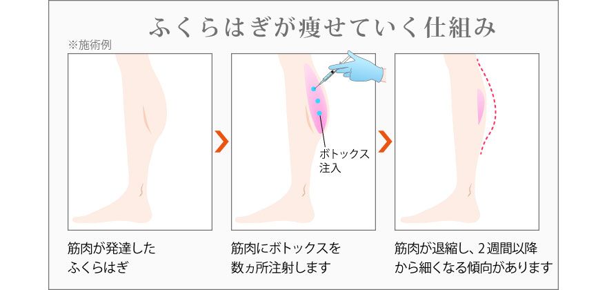 ボトックス注射でふくらはぎが細くなっていく仕組み