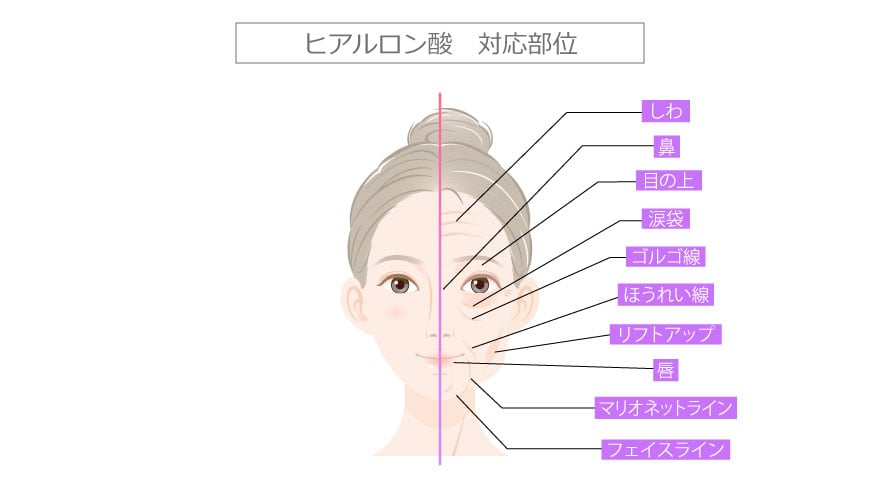 ヒアルロン酸注射　対応部位