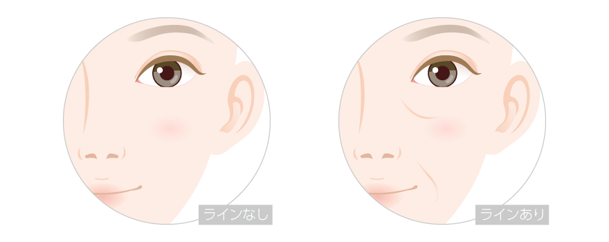 顔のしわを改善したい