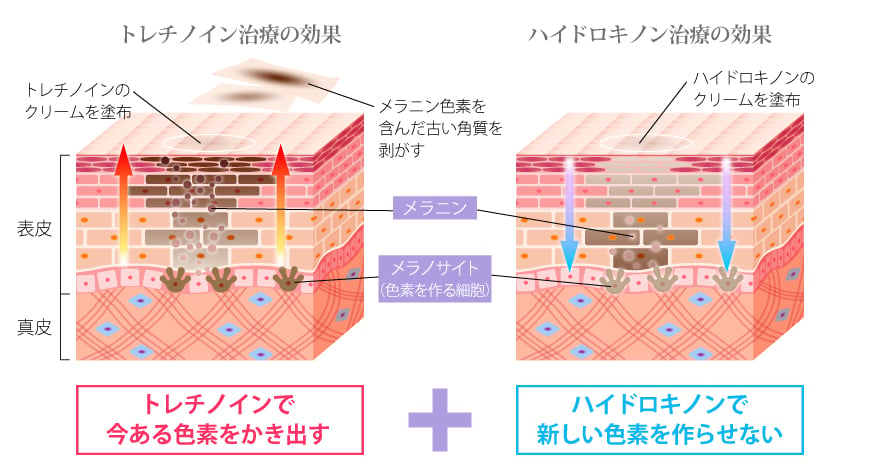 トレチノインでメラニン色素を追い出す｜ハイドロキノンで新しいメラニン色素の生産を抑制する