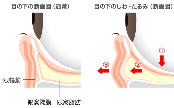 目の下のふくらみの原因は眼窩脂肪が押し出されることによる