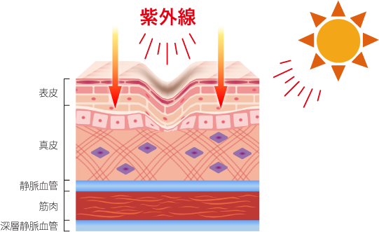 紫外線に当たる肌の断面図のイラスト