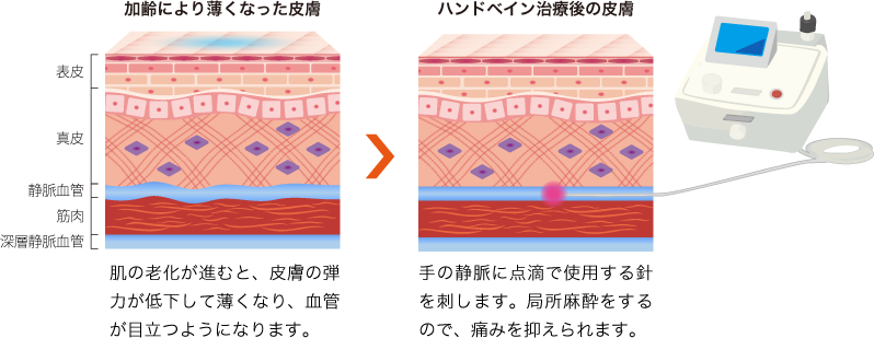 ハンドベインの治療を説明している皮膚の断面図のイラスト