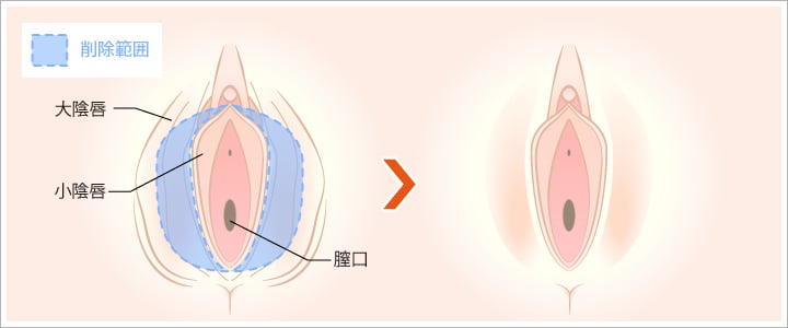 大陰唇の切除前と切除後のイラスト