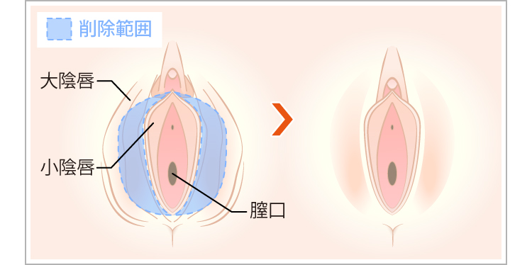 大陰唇の切除前と切除後のイラスト