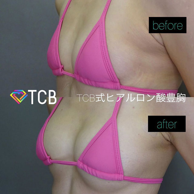 篠永医師が行った豊胸・バストの施術のビフォーアフター01