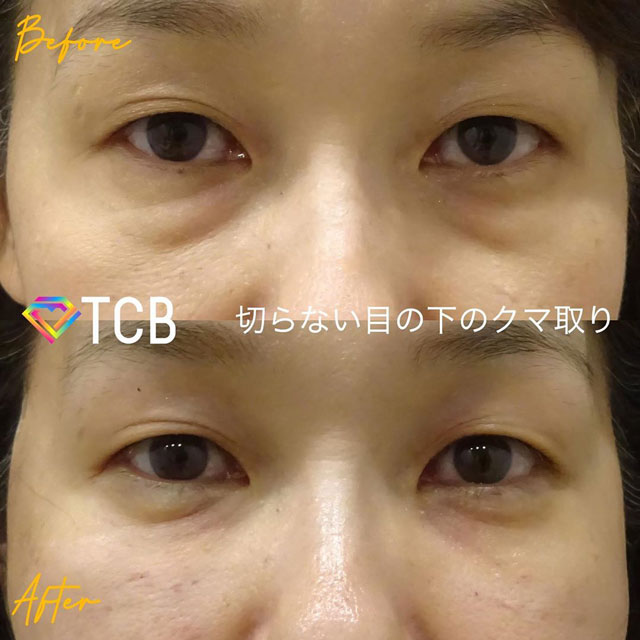 篠永医師が行った目元のクマ・しわ・たるみ取りの施術のビフォーアフター01