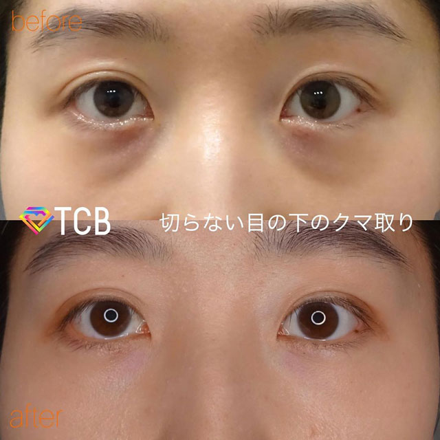 篠永医師が行った目元のクマ・しわ・たるみ取りの施術のビフォーアフター02