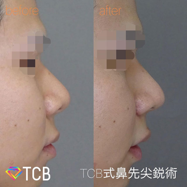 篠永医師が行った鼻の施術のビフォーアフター01